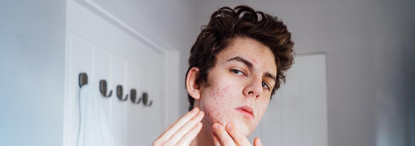 Male looking at his acne in mirror