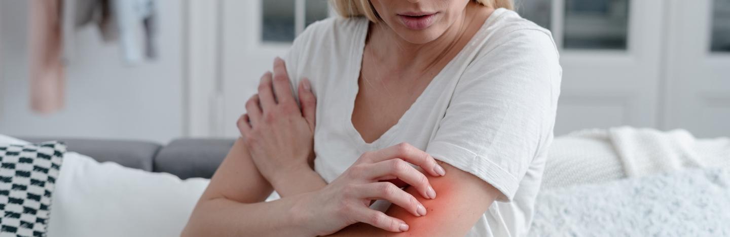 atopic dermatitis