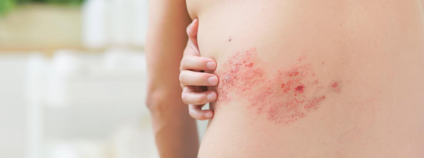 Herpes Zoster